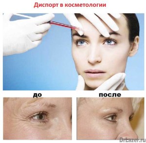Диспорт в косметології